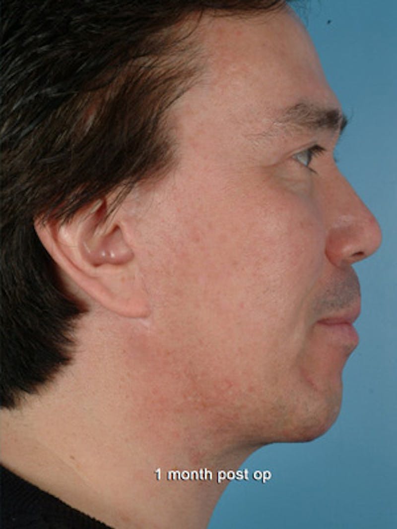 Liposuction Submental Before & After Gallery - Patient 328938 - Image 2