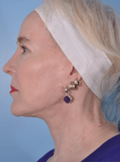 Neck Lift Before & After Gallery - Patient 311416 - Image 2