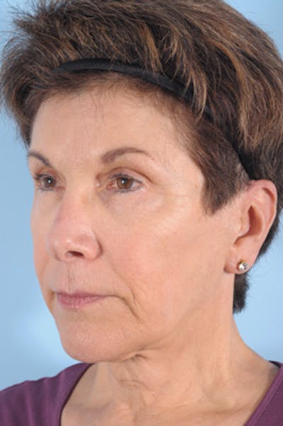 Liposuction Submental Before & After Gallery - Patient 181666 - Image 1