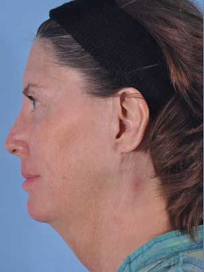 Liposuction Submental Before & After Gallery - Patient 220198 - Image 1