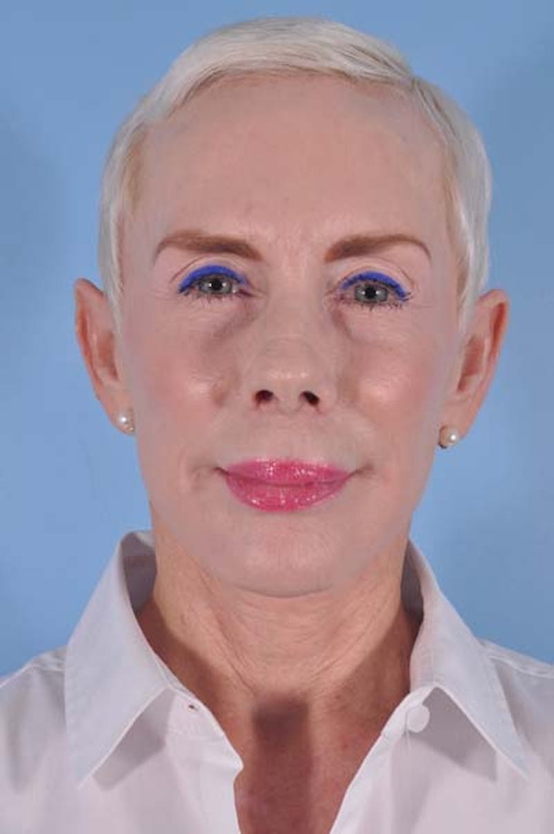 Neck Lift Before & After Gallery - Patient 156789 - Image 3