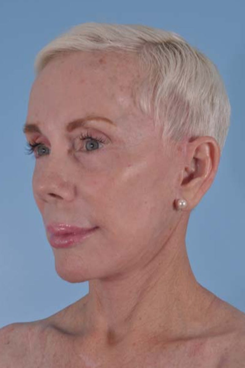 Neck Lift Before & After Gallery - Patient 156789 - Image 6