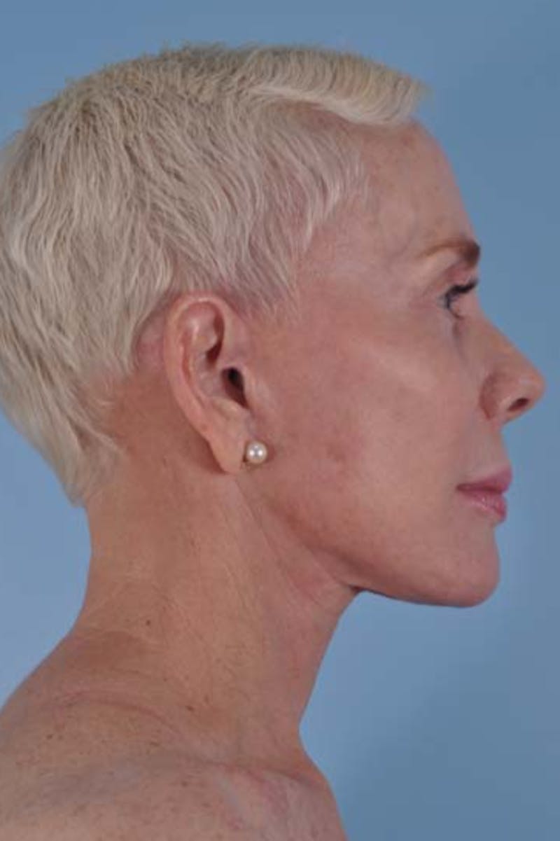 Neck Lift Before & After Gallery - Patient 156789 - Image 8