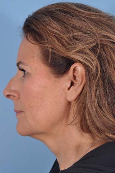 Neck Lift Before & After Gallery - Patient 183208 - Image 1