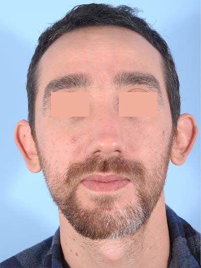 Otoplasty (Ear Surgery) Before & After Gallery - Patient 211184 - Image 1