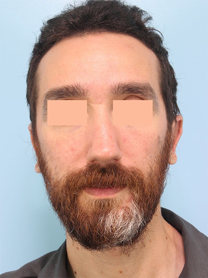 Otoplasty (Ear Surgery) Before & After Gallery - Patient 211184 - Image 2