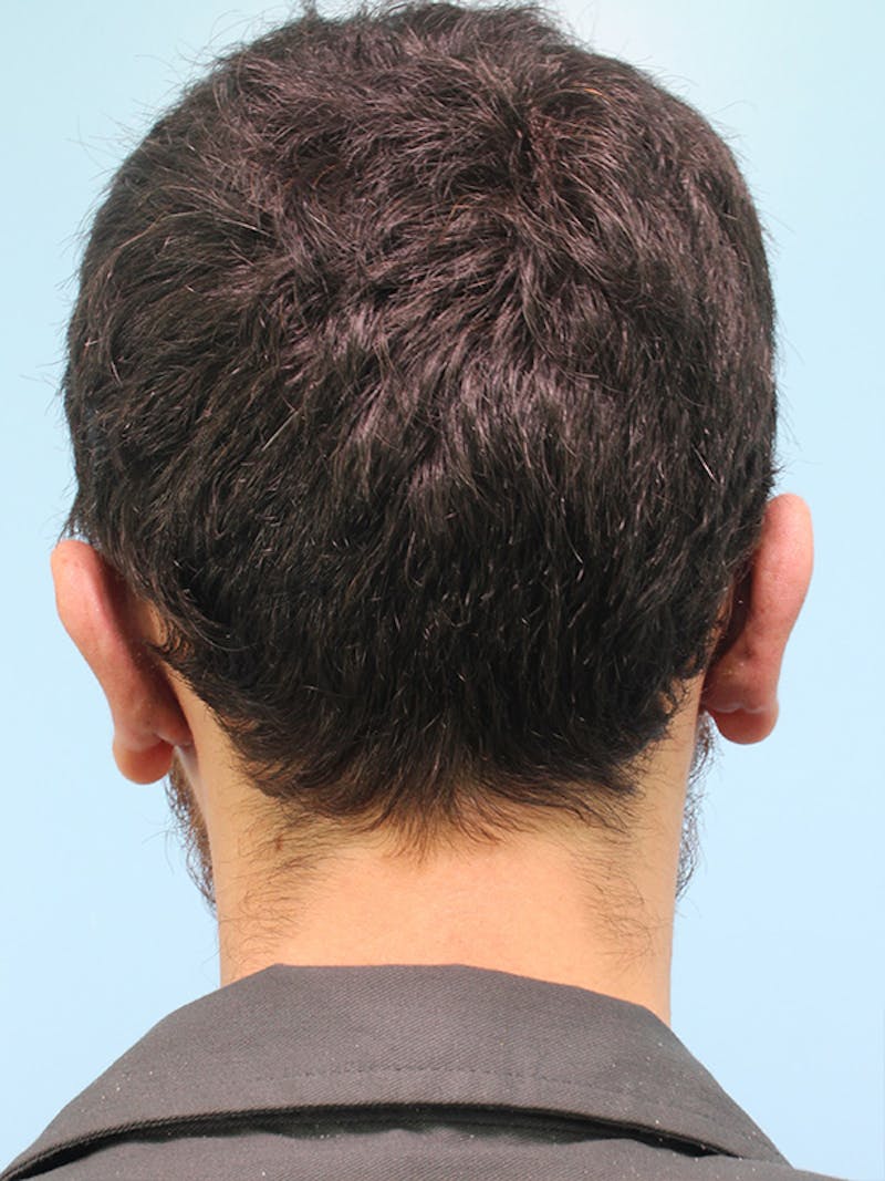 Otoplasty (Ear Surgery) Before & After Gallery - Patient 211184 - Image 4