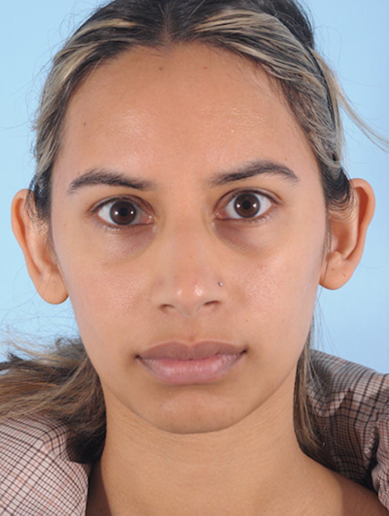 Otoplasty (Ear Surgery) Before & After Gallery - Patient 426884 - Image 1