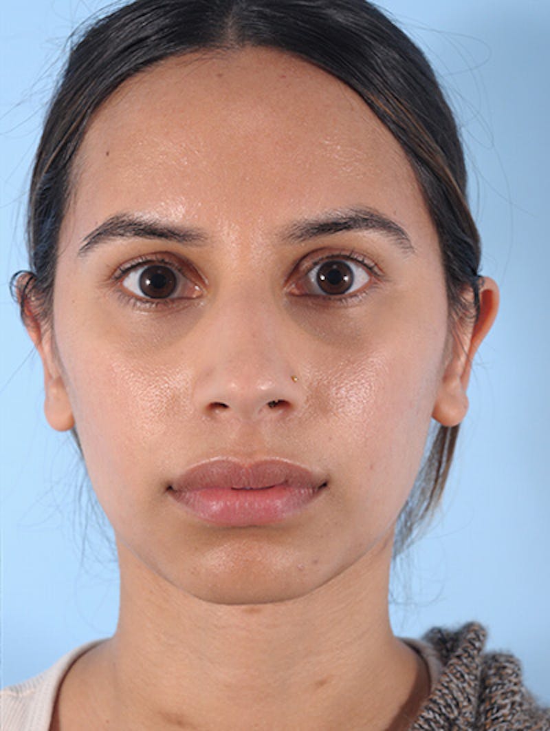 Otoplasty (Ear Surgery) Before & After Gallery - Patient 426884 - Image 2