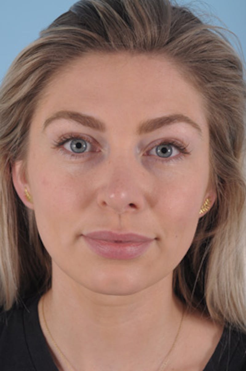 Septoplasty Before & After Gallery - Patient 412827 - Image 1