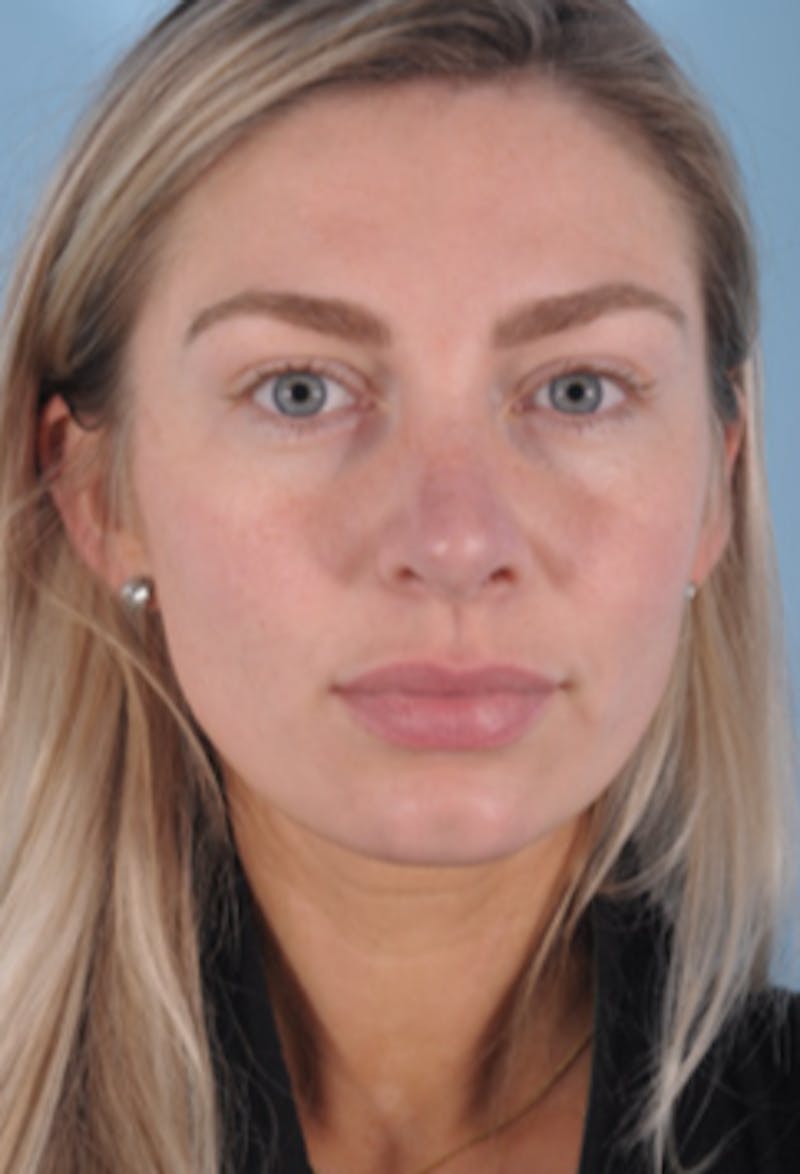 Septoplasty Before & After Gallery - Patient 412827 - Image 2