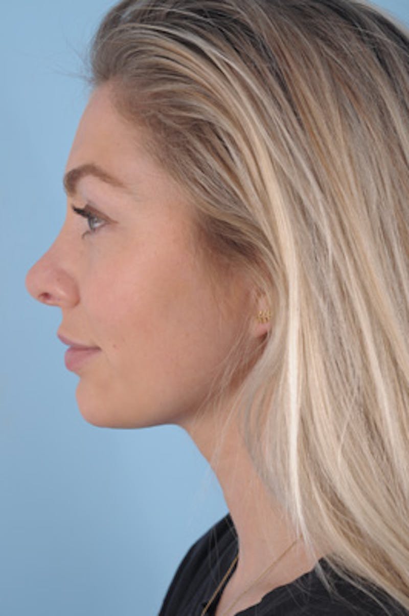 Septoplasty Before & After Gallery - Patient 412827 - Image 3