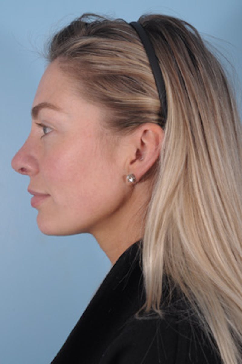 Septoplasty Before & After Gallery - Patient 412827 - Image 4