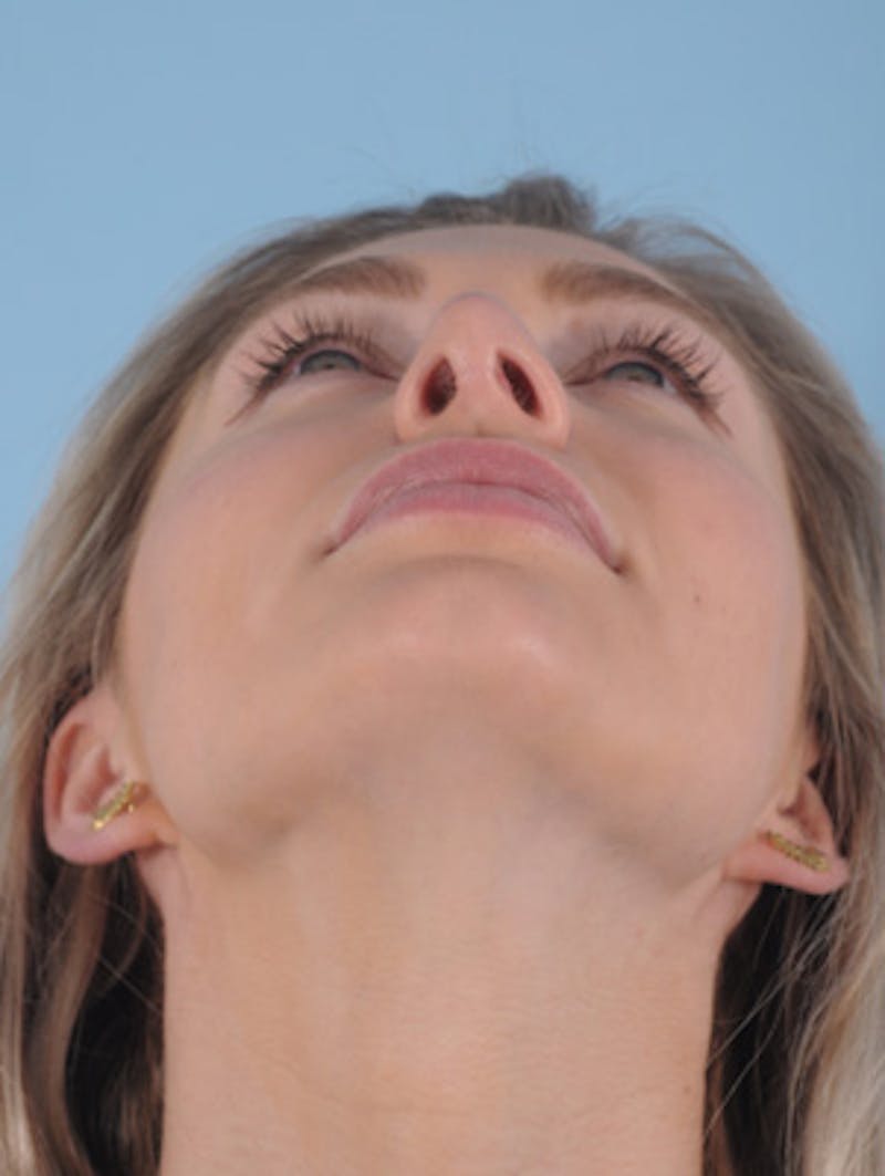 Septoplasty Before & After Gallery - Patient 412827 - Image 5