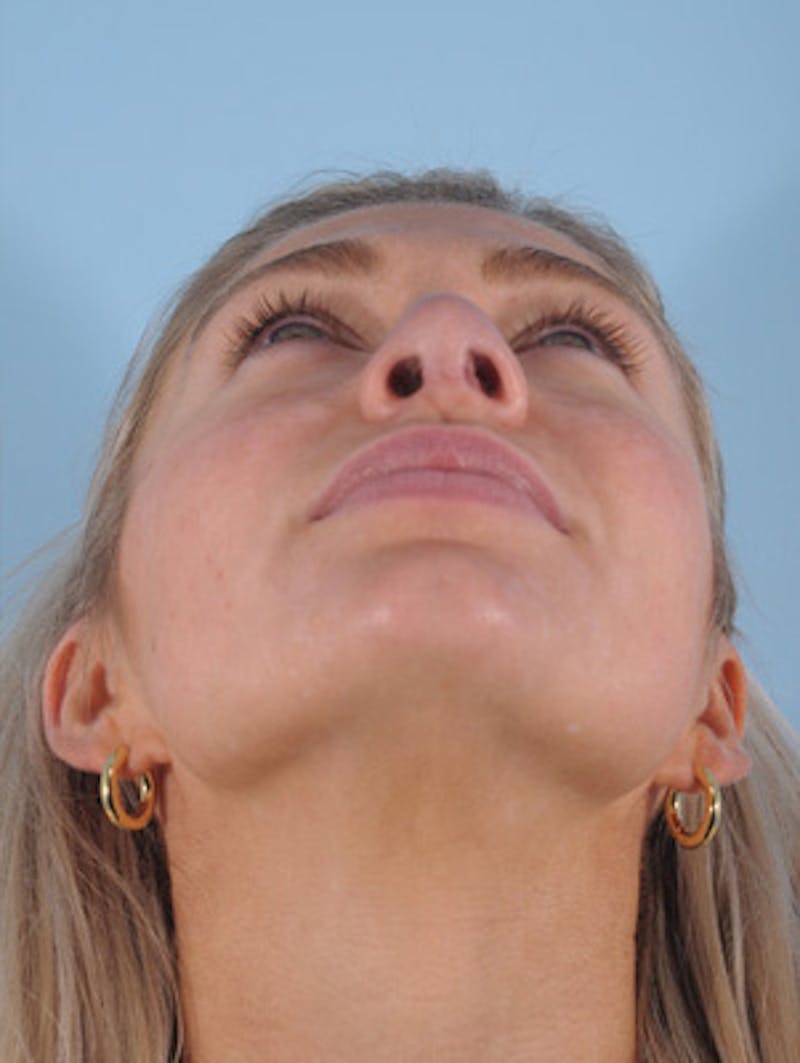 Septoplasty Before & After Gallery - Patient 412827 - Image 6