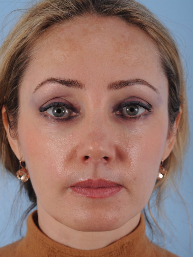 Silhouette Lift Before & After Gallery - Patient 176341 - Image 2