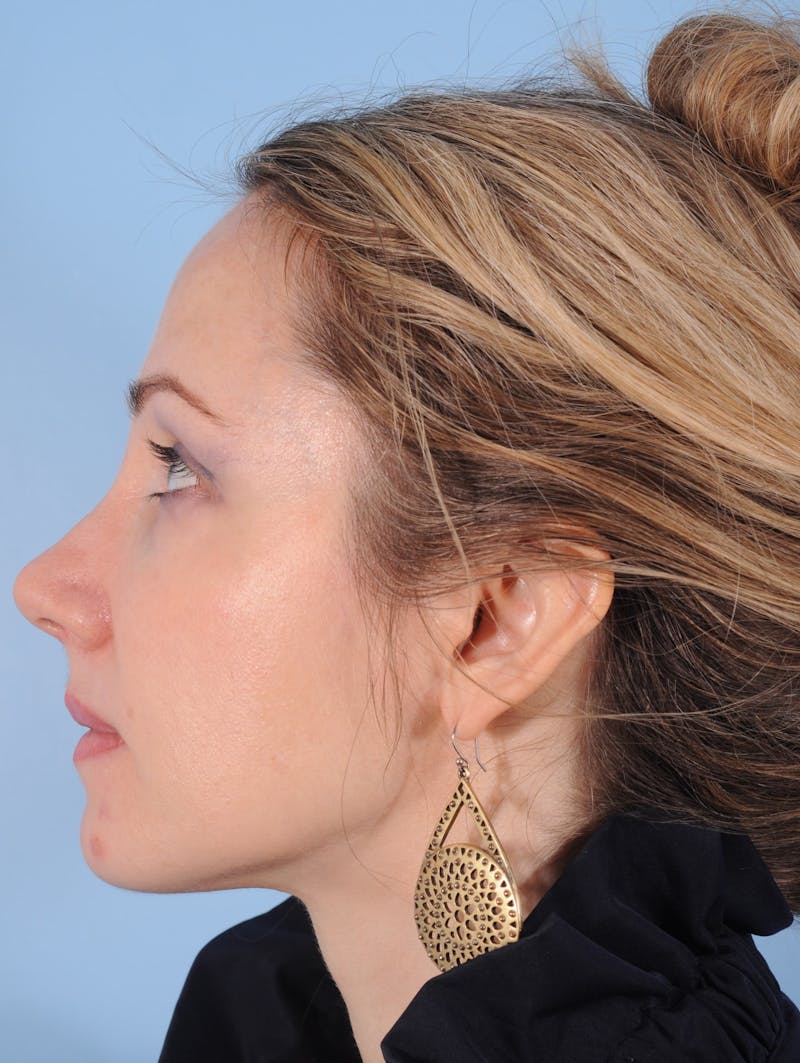 Silhouette Lift Before & After Gallery - Patient 176341 - Image 5