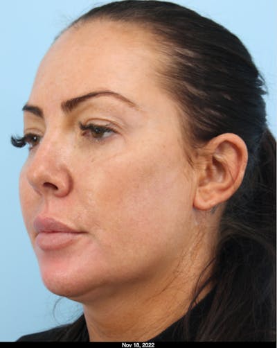 Silhouette Lift Before & After Gallery - Patient 387482 - Image 1