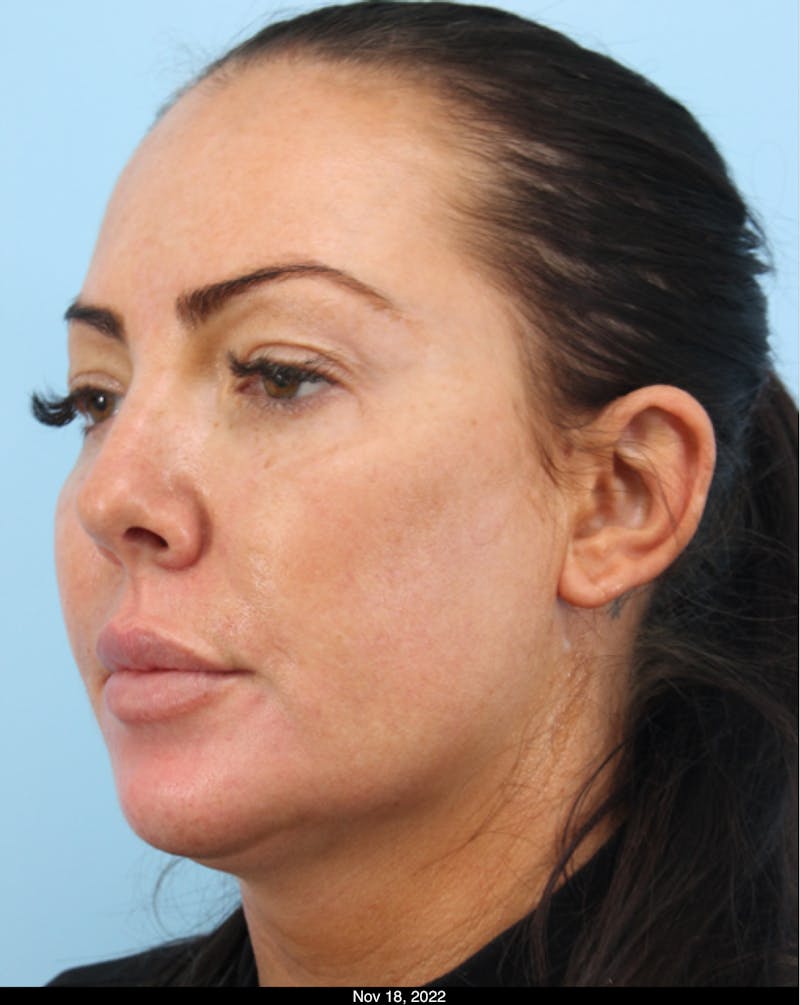 Thread Lift Before & After Gallery - Patient 891818 - Image 1