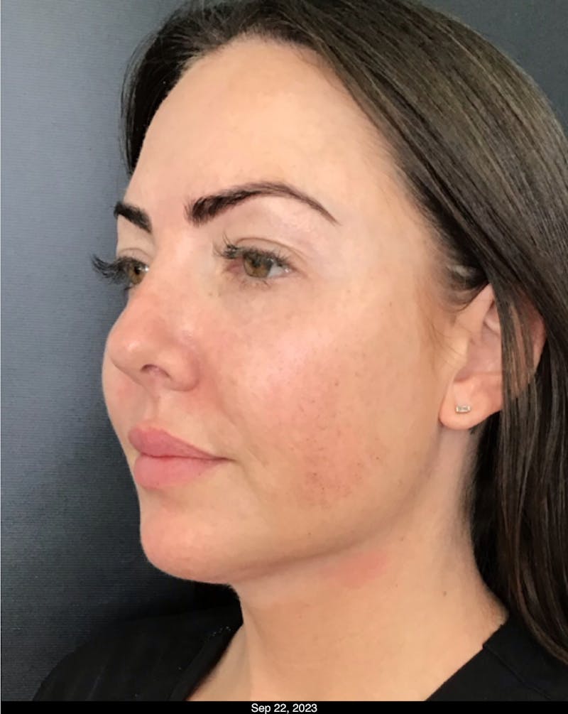 Thread Lift Before & After Gallery - Patient 891818 - Image 2