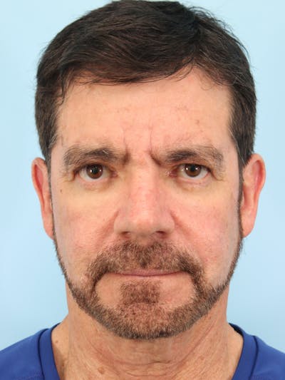 Silhouette Lift Before & After Gallery - Patient 357861 - Image 1