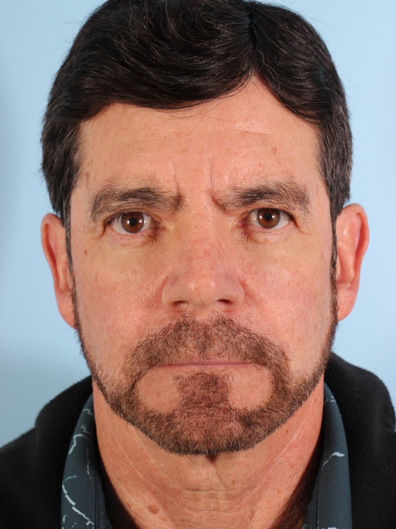 Silhouette Lift Before & After Gallery - Patient 357861 - Image 2