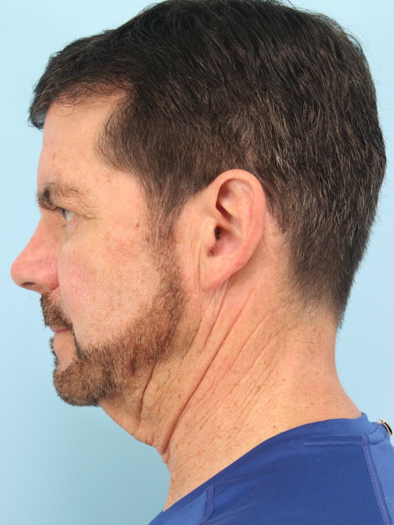 Silhouette Lift Before & After Gallery - Patient 357861 - Image 3
