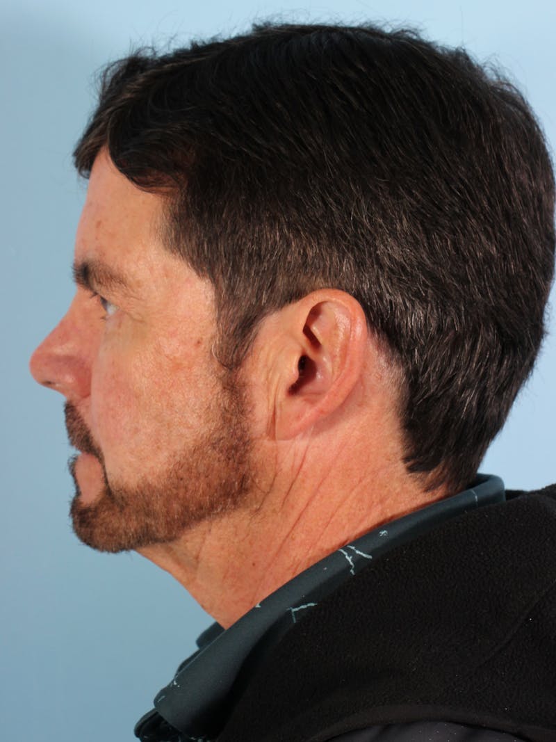 Silhouette Lift Before & After Gallery - Patient 357861 - Image 4