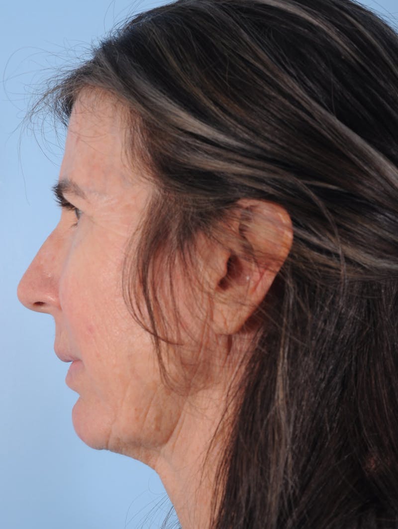 Silhouette Lift Before & After Gallery - Patient 321676 - Image 1