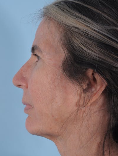 Silhouette Lift Before & After Gallery - Patient 321676 - Image 2