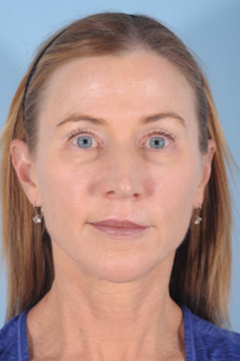 Silhouette Lift Before & After Gallery - Patient 603779 - Image 1