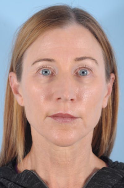 Silhouette Lift Before & After Gallery - Patient 603779 - Image 2