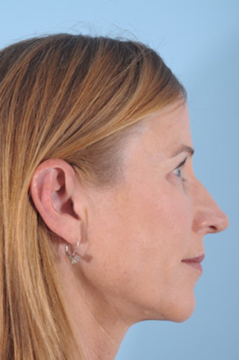 Silhouette Lift Before & After Gallery - Patient 603779 - Image 3