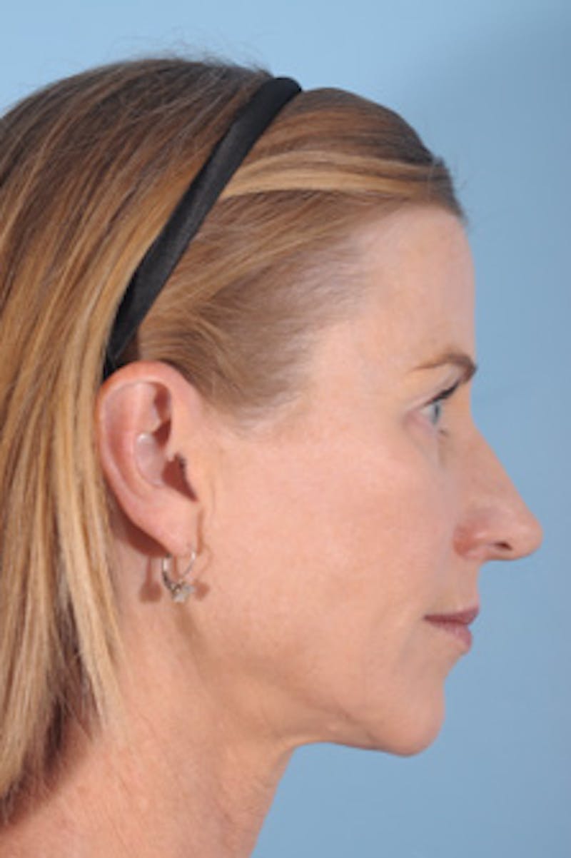 Silhouette Lift Before & After Gallery - Patient 603779 - Image 4