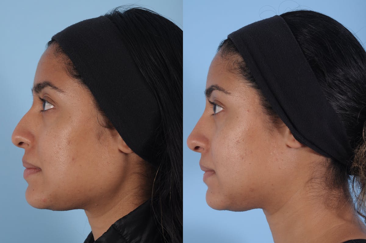 Non-Surgical Rhinoplasty Before & After Gallery - Patient 273486 - Image 1