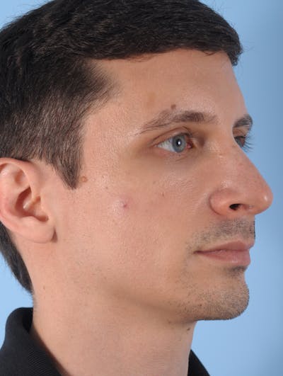 Dermal Fillers Before & After Gallery - Patient 179956 - Image 1