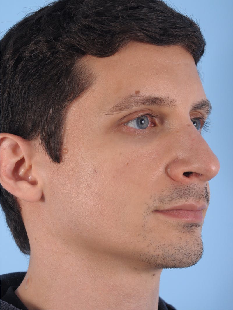 Dermal Fillers Before & After Gallery - Patient 179956 - Image 2