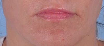 Dermal Fillers Before & After Gallery - Patient 363073 - Image 1