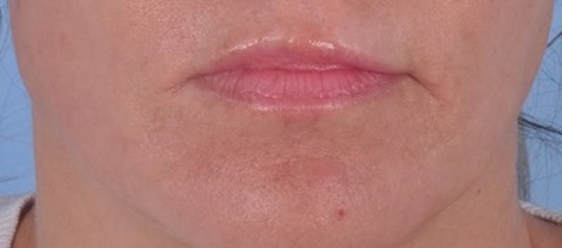 Dermal Fillers Before & After Gallery - Patient 363073 - Image 1