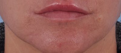 Dermal Fillers Before & After Gallery - Patient 363073 - Image 2