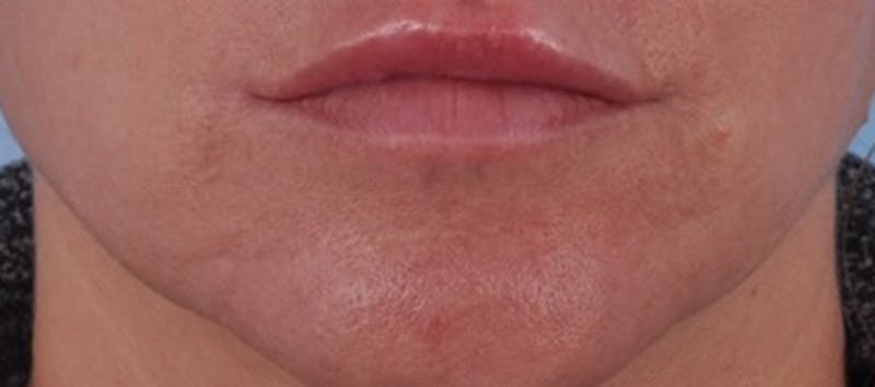 Dermal Fillers Before & After Gallery - Patient 363073 - Image 2