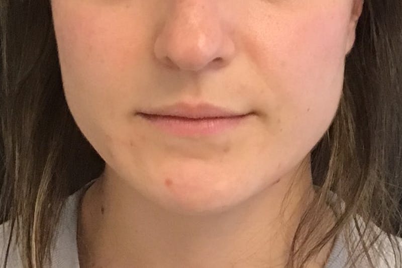 Dermal Fillers Before & After Gallery - Patient 424330 - Image 1