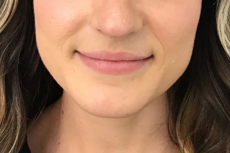 Dermal Fillers Before & After Gallery - Patient 424330 - Image 2