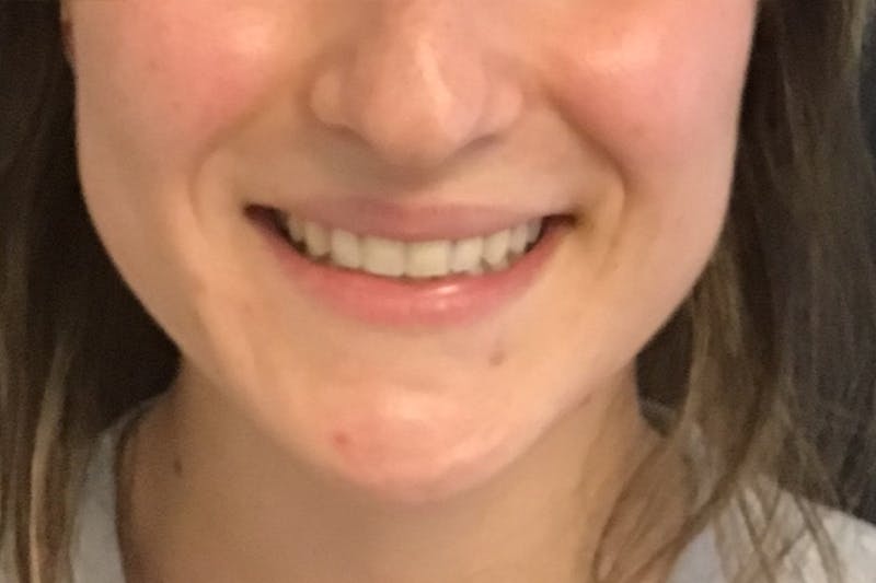 Dermal Fillers Before & After Gallery - Patient 424330 - Image 3