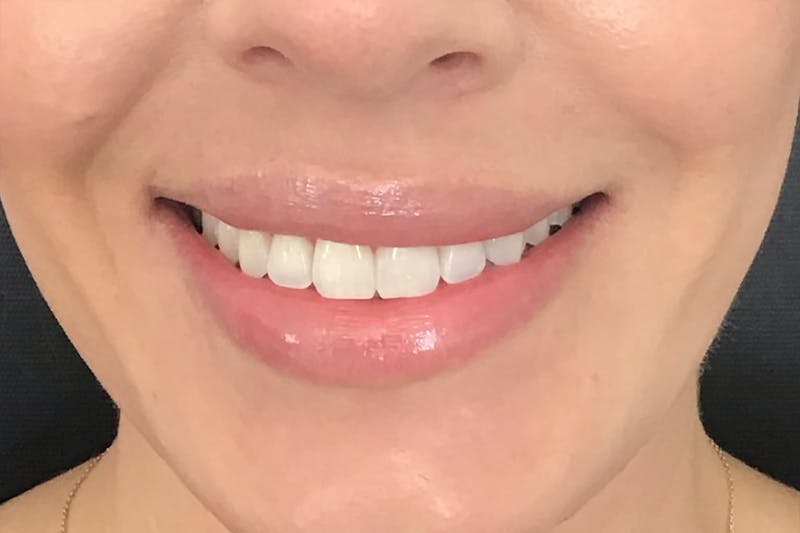 Dermal Fillers Before & After Gallery - Patient 348385 - Image 1