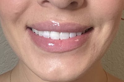 Dermal Fillers Before & After Gallery - Patient 348385 - Image 2