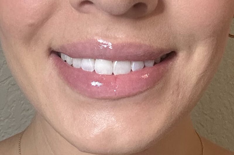 Dermal Fillers Before & After Gallery - Patient 348385 - Image 2