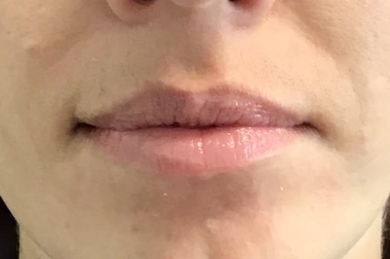 Dermal Fillers Before & After Gallery - Patient 348385 - Image 3