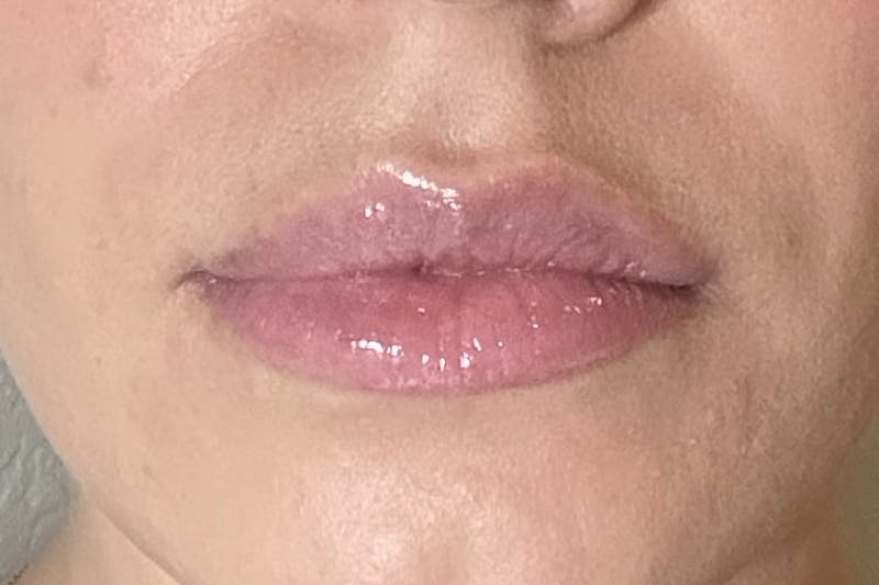 Dermal Fillers Before & After Gallery - Patient 348385 - Image 4