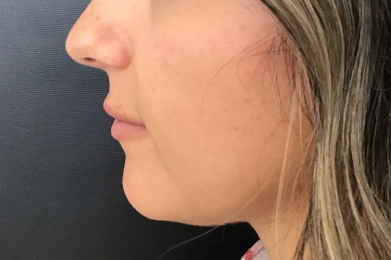 Dermal Fillers Before & After Gallery - Patient 364978 - Image 4